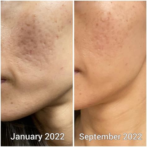 TCA Cross Progress Update : r/AcneScars .